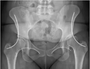 Anteroposterior pelvic X-ray showing bilateral hip joints with surgical planning annotation lines indicating hip replacement templating