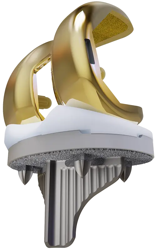 Stryker Triathlon Oxidized Zirconium total knee replacement system — fully assembled knee implant with gold-toned femoral component, white polyethylene insert, and porous tibial baseplate on transparent background